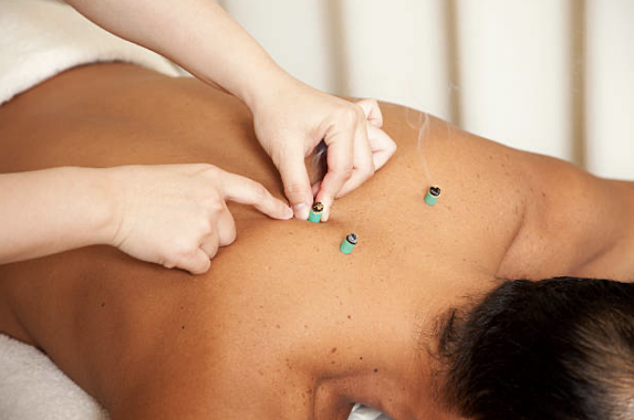 Moxibustion treatment example 3